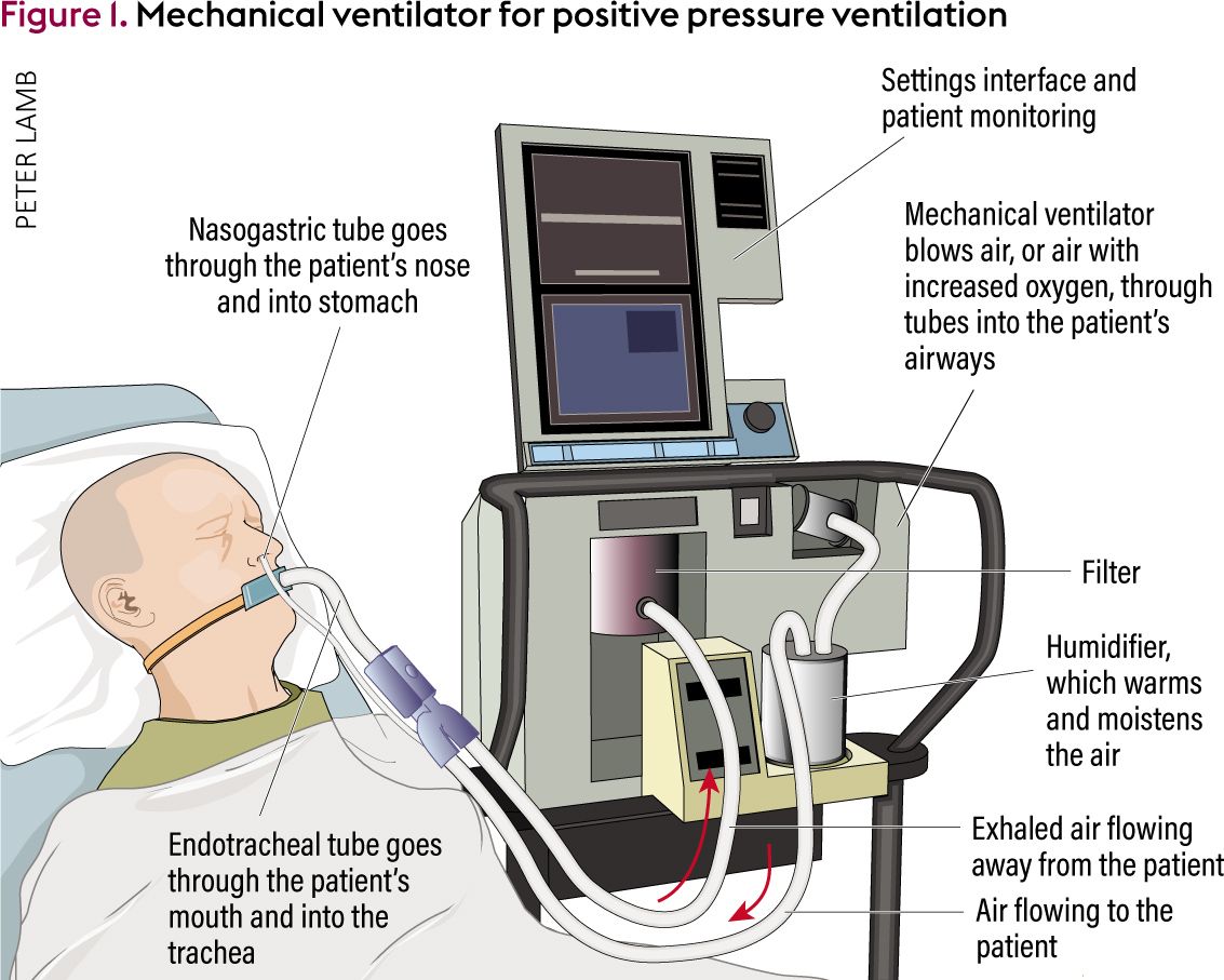 Ventilator Use in the ICU