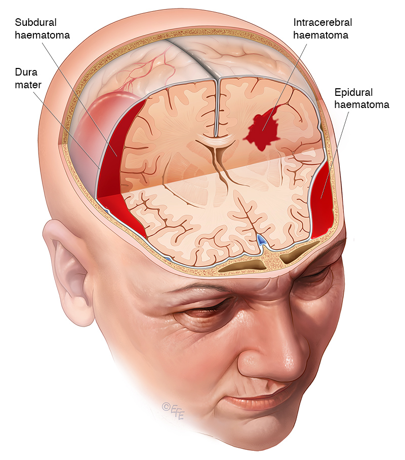 symptoms of brain bleed