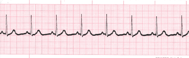 Atrial