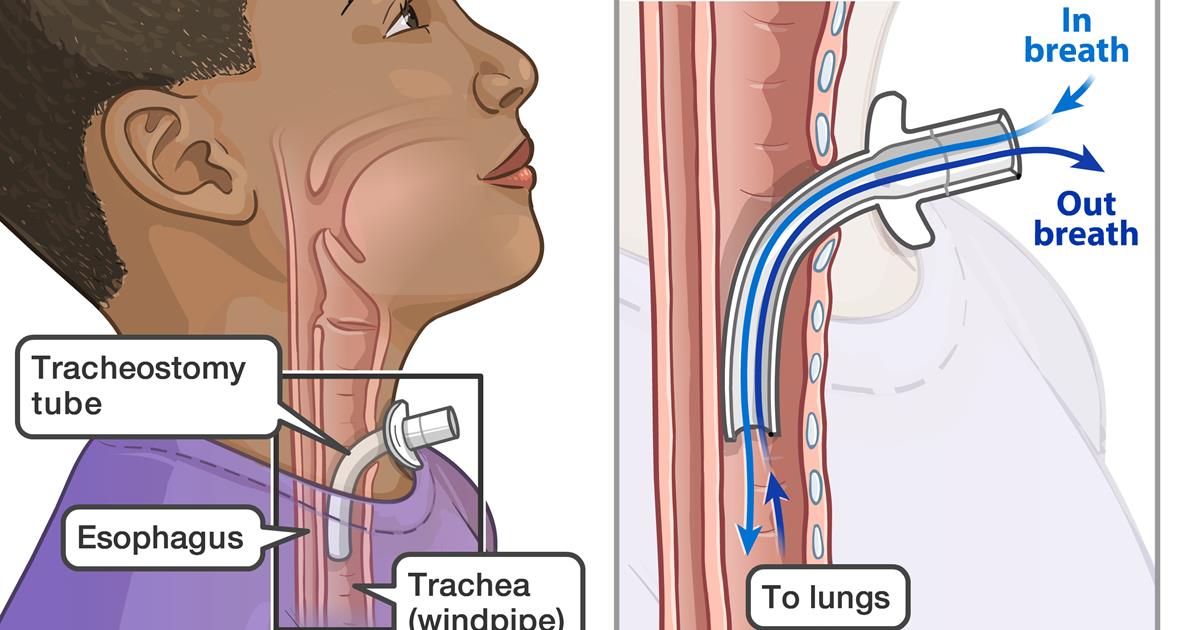 Ventilator Use in the ICU