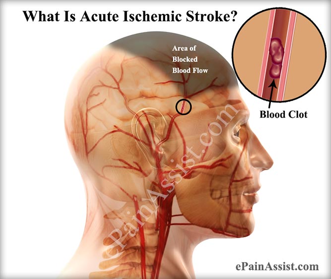 ischemic stroke case study answers
